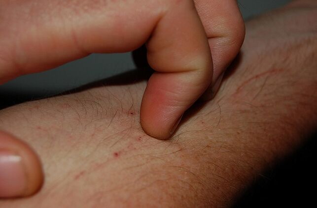 bőrviszketés, mint a paraziták jelenlétének tünete